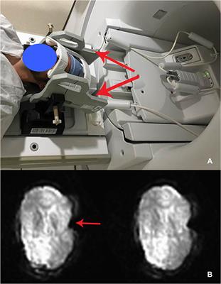 Functional Neuroimaging During <mark class="highlighted">Asleep</mark> DBS Surgery: A Proof of Concept Study